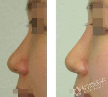 假体隆鼻可能出现的后遗症有哪些 假体隆鼻前后对比照