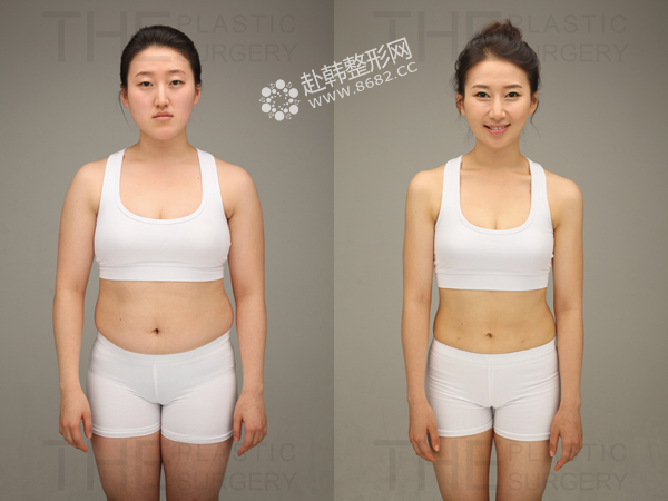 |吸脂减肥术潜在的三个风险 推荐韩国专家金洙喆