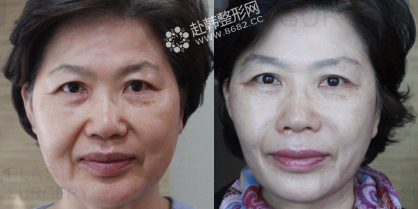 面部提升除皱手术前后对比照|韩国专家金洙喆解析：微创面部提升除皱术