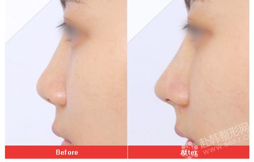 膨体隆鼻术后如何护理，假体隆鼻效果对比图