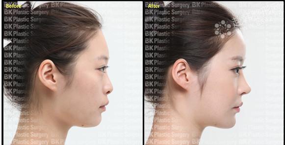 假体隆鼻前后对比照（案例提供：韩国BK整形外科）