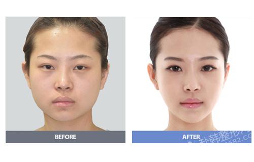下颌角整形磨骨瘦脸的效果怎么样 下颌角整形前后对比照
