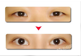 【双眼皮整容案例】小眼到大眼的重生蜕变记