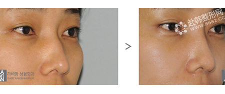 驼峰鼻矫正前后对比照，驼峰鼻矫正的风险