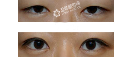 双眼皮术后怎么消肿 韩式双眼皮对比照