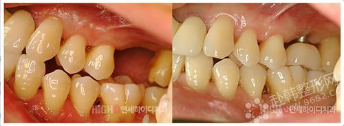 牙齿修复前后对比照|牙齿修复有几种方法