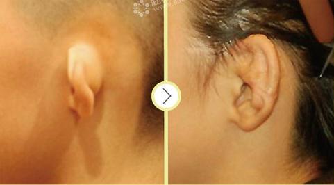 韩国耳部整形的医生是哪位？