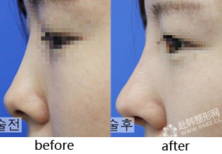 爱贝芙隆鼻手术的优点 注射隆鼻对比照