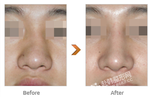 歪鼻矫正的方法及效果 歪鼻整形前后对比照