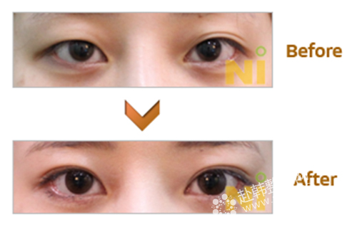 韩式双眼皮有什么优点