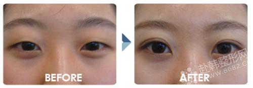 8682详细介绍双眼皮手术哪种方法好