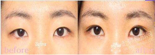 微创韩式双眼皮手术的方法及效果 双眼皮整形对比照