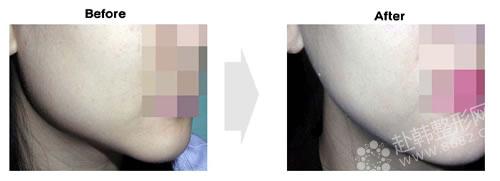 下颌角整形适应哪些人群？术后如何护理？