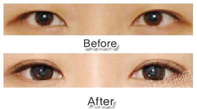 做切开双眼皮修复手术时需要注意的事项