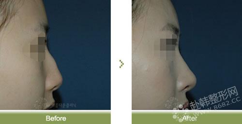 告别畸形鼻 驼峰鼻的四种矫正方法