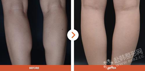 瘦腿瘦小腿的效果能维持多久