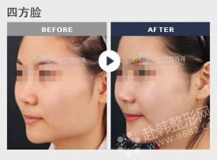 韩式改脸型手术后多久能恢复