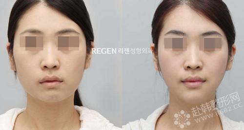 国庆想去韩国做眼鼻脸整形 哪个医院比较好？ 