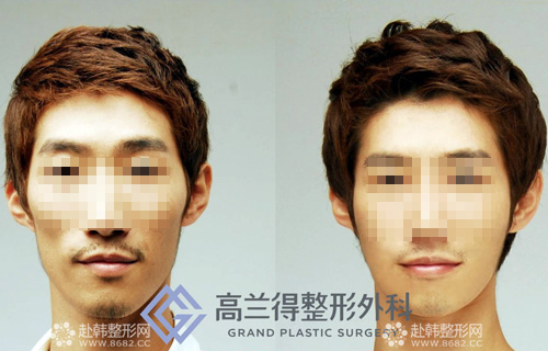 韩式改脸型前后对比图