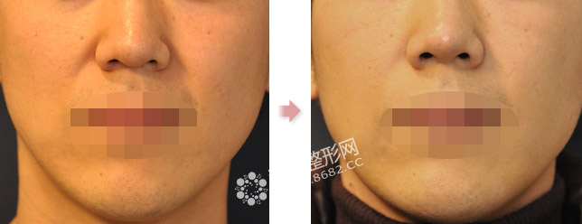 鼻唇沟纹怎么去除，鼻唇沟填充法令纹前后对比照