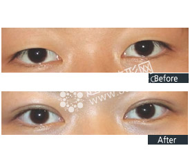 埋线双眼皮效果维持时间受哪些因素影响?埋线双眼皮前后对比照