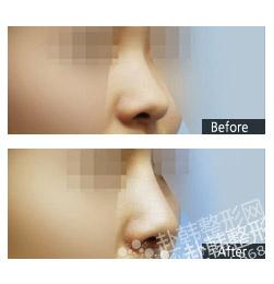 注射隆鼻的方法及常用注射材料 注射隆鼻前后对比效果图