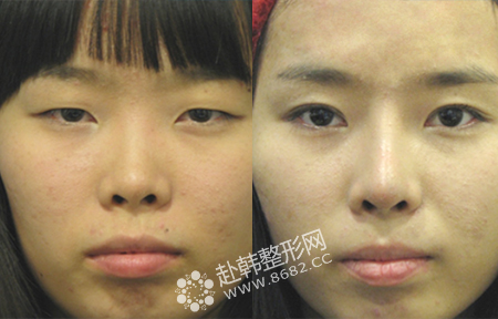 隆鼻前后对比照；韩国整形专家介绍，隆鼻手术后一般1-2小时开始肿胀，24小时左右达到高峰。隆鼻手术后消肿的方法：