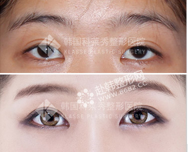 如何避免开眼角失败 开眼角手术前后对比照