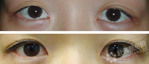 埋线双眼皮手术后的恢复过程 埋线双眼皮前后对比照