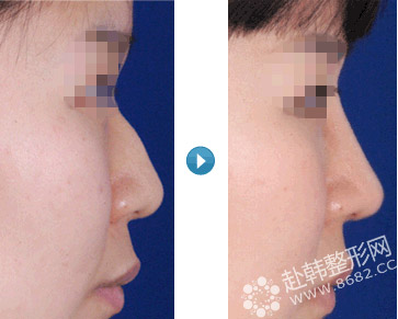 驼峰鼻怎么办 驼峰鼻矫正的手术方法 驼峰鼻整形效果对比图