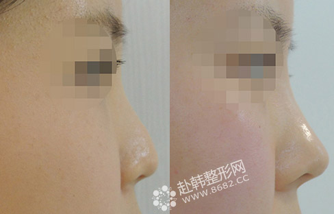 什么是韩式三段式隆鼻术? 隆鼻前后对比照