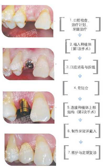 种植牙齿的过程