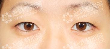 韩国埋线双眼皮手术过程