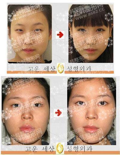 韩国整形医院韩式双眼皮对比照片