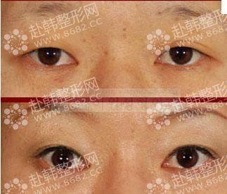 切除眉术后进行修复的眉形对比照片