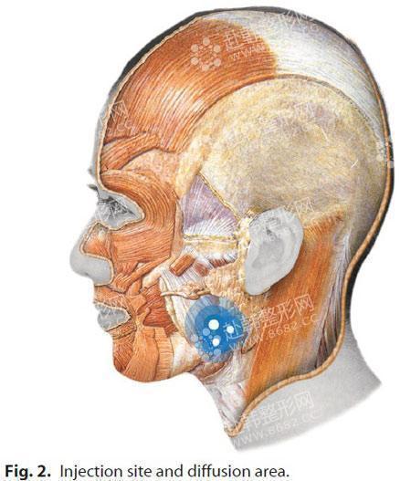 瘦脸注射正确部位