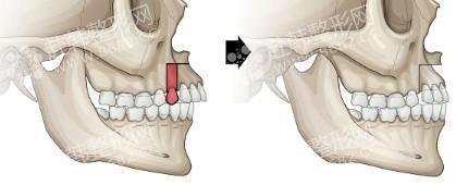 突嘴矫正手术之上颚前部截骨术